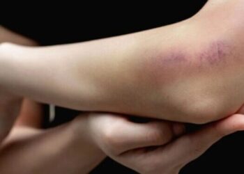 Luka Memar Usai Terbentur? Ini 6 Langkah Cepat Mengatasinya